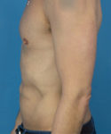 after liposuction male patient left side view case 2590
