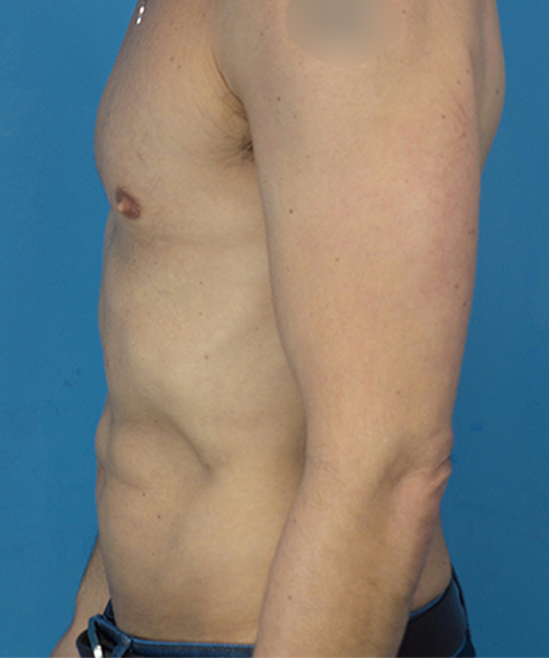 after liposuction male patient left side view case 2590