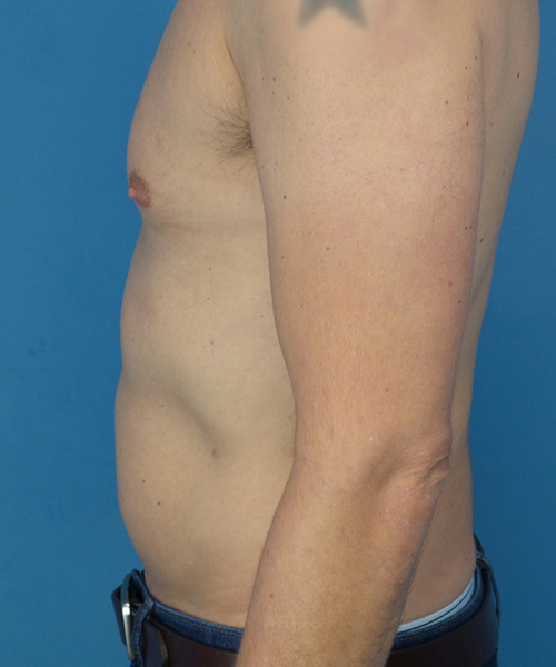 before liposuction male patient left side view case 2590