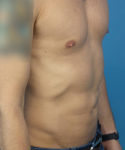 after liposuction male patient right angle view case 2590