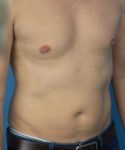 before liposuction male patient right angle view case 2590