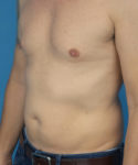 before liposuction male patient left angle view case 2590