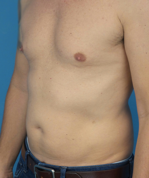 before liposuction male patient left angle view case 2590