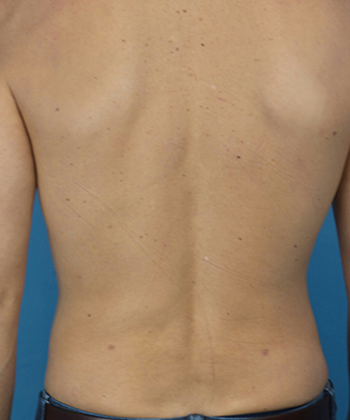 after liposuction male patient back view case 2590