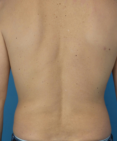 before liposuction male patient back view case 2590