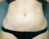 before liposuction female patient front view case 4806 | Crispin Plastic Surgery Atlanta, GA
