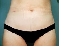 after liposuction female patient front view case 4806 | Crispin Plastic Surgery Atlanta, GA