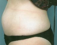 before liposuction left side view case 4806 | Crispin Plastic Surgery Atlanta, GA