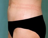 after liposuction left side view case 4806 | Crispin Plastic Surgery Atlanta, GA