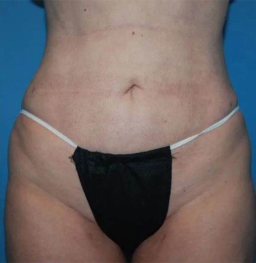 after liposuction female patient front view case 4811 | Crispin Plastic Surgery Atlanta, GA