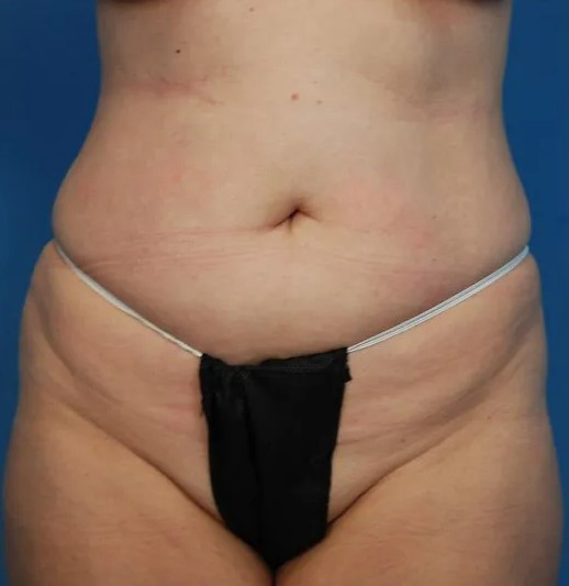 before liposuction female patient front view case 4811 | Crispin Plastic Surgery Atlanta, GA