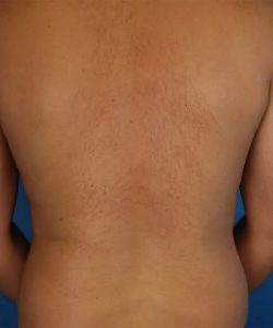 before liposuction male patient back view case 4814 | Crispin Plastic Surgery Atlanta, GA