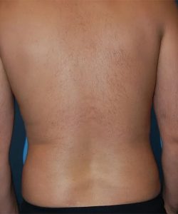 after liposuction male patient back view case 4814 | Crispin Plastic Surgery Atlanta, GA