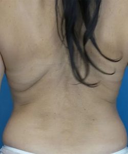 before liposuction back view case 4817 | Crispin Plastic Surgery Atlanta, GA