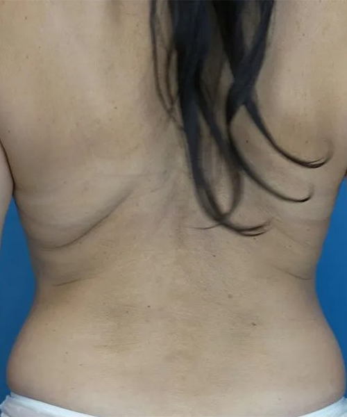 before liposuction back view case 4817 | Crispin Plastic Surgery Atlanta, GA