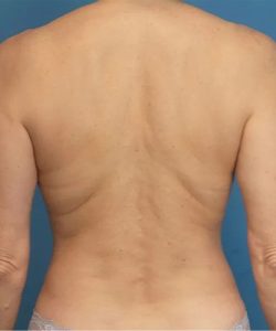 after liposuction back view case 4817 | Crispin Plastic Surgery Atlanta, GA