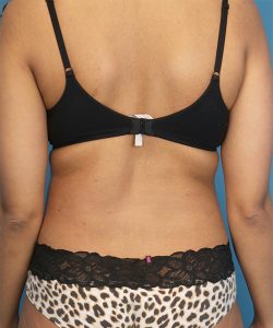 before liposuction back view female patient case 1586