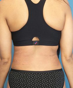 after liposuction back view female patient case 1586