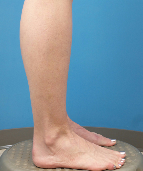 after liposuction lower right side leg view female patient case 1577
