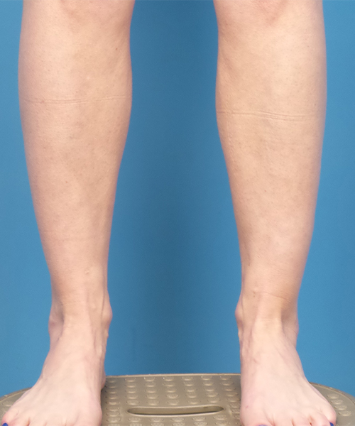 before liposuction lower front leg view female patient case 1577