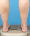 before liposuction lower back leg view female patient case 1577