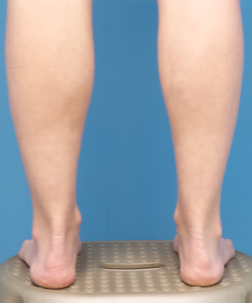 front liposuction lower back leg view female patient case 1577