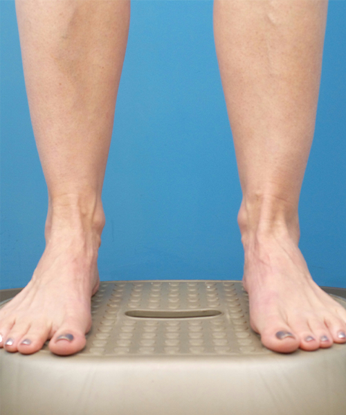 after liposuction lower front leg view female patient case 1577