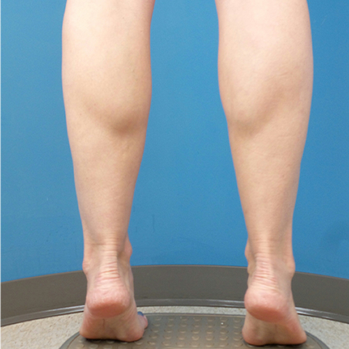 before liposuction lower leg flex view female patient case 1577