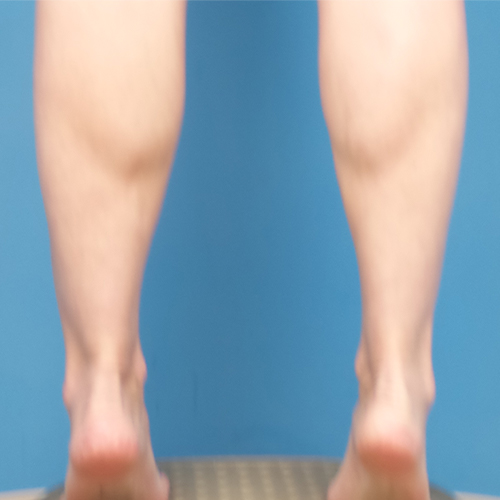 after liposuction lower leg flex view female patient case 1577