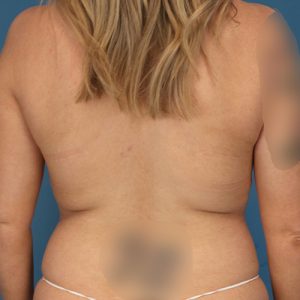 before liposuction front view female patient case 1873