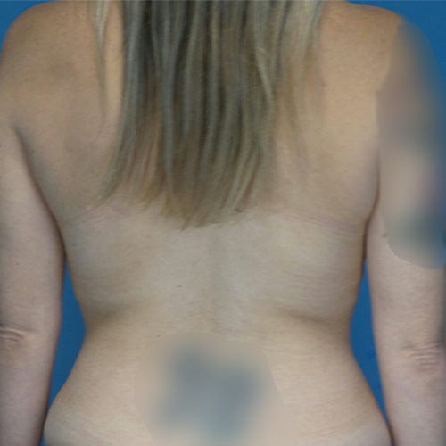 after liposuction front view female patient case 1873