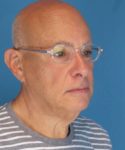 before male facelift right angle view male patient case 2666