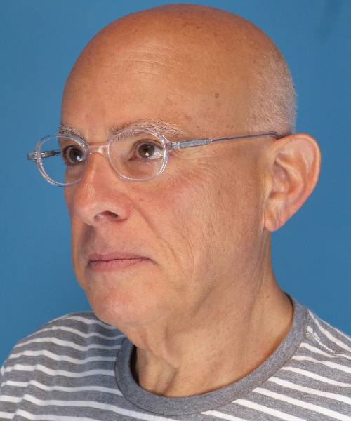 before male facelift left angle view male patient case 2666
