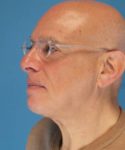 after male facelift left angle view male patient case 2666
