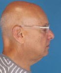 before male facelift right side view male patient case 2666
