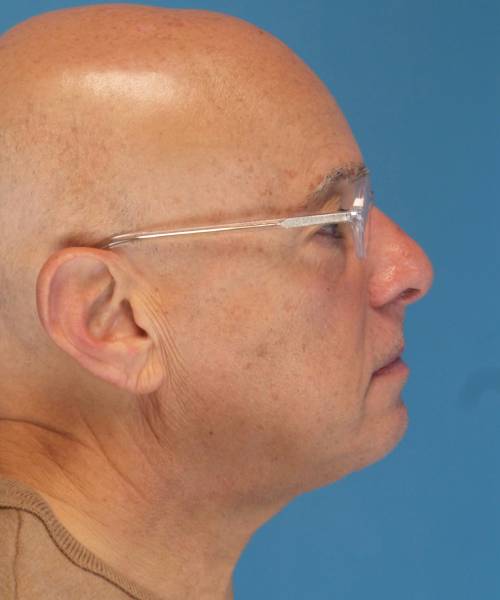 after male facelift right side view male patient case 2666