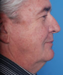 before male facelift right side view male patient case 2676