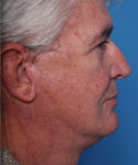after male facelift right side view male patient case 2676
