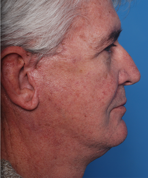 after male facelift right side view male patient case 2676