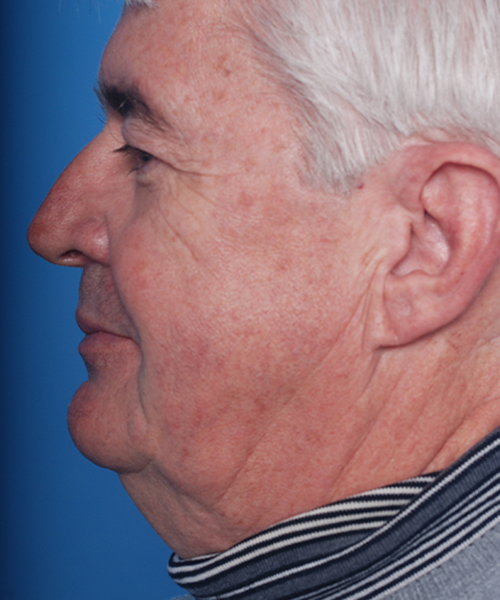 before male facelift left side view male patient case 2676