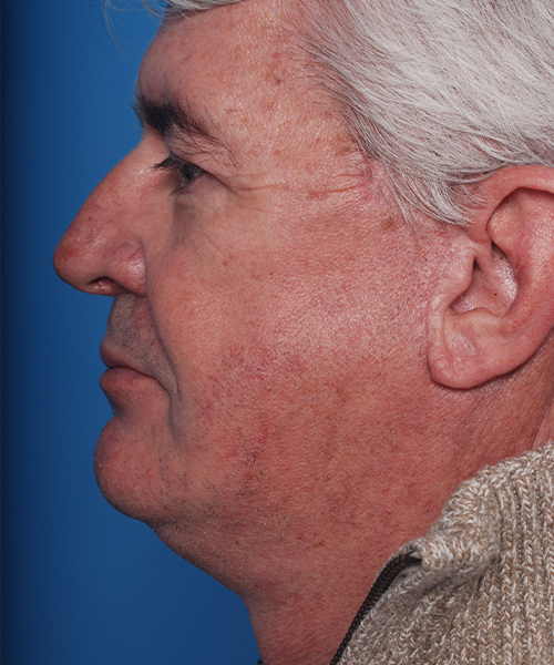 after male facelift left side view male patient case 2676