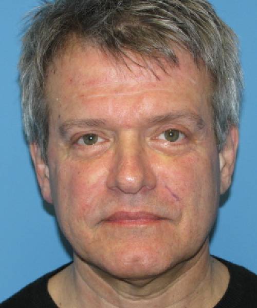 before male facelift front view male patient case 2680