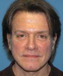 after male facelift front view male patient case 2680
