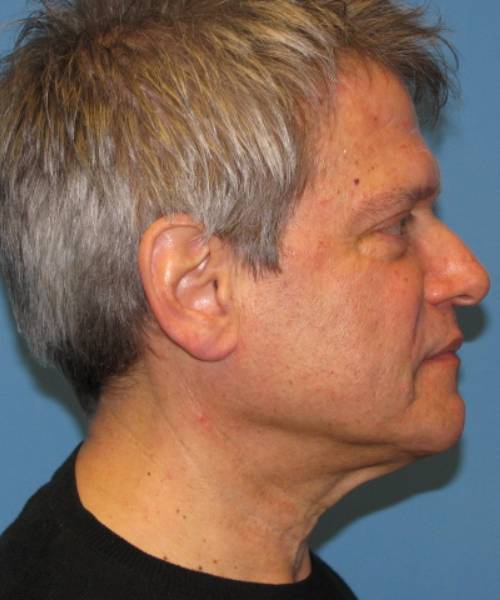 before male facelift right side view male patient case 2680