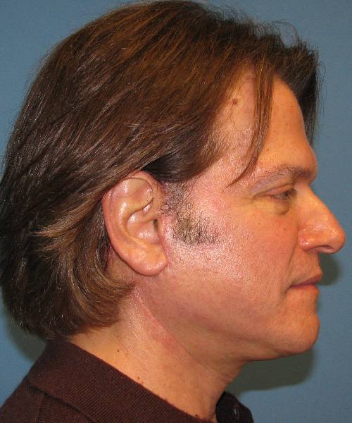 after male facelift right side view male patient case 2680