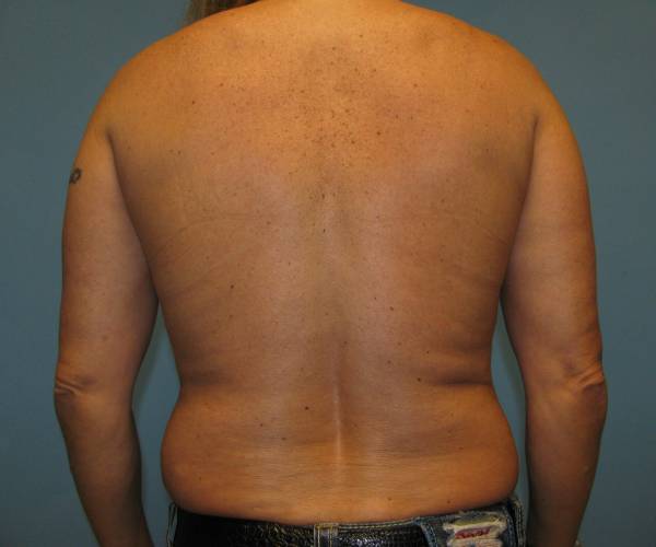 before liposuction back view male patient case 2631