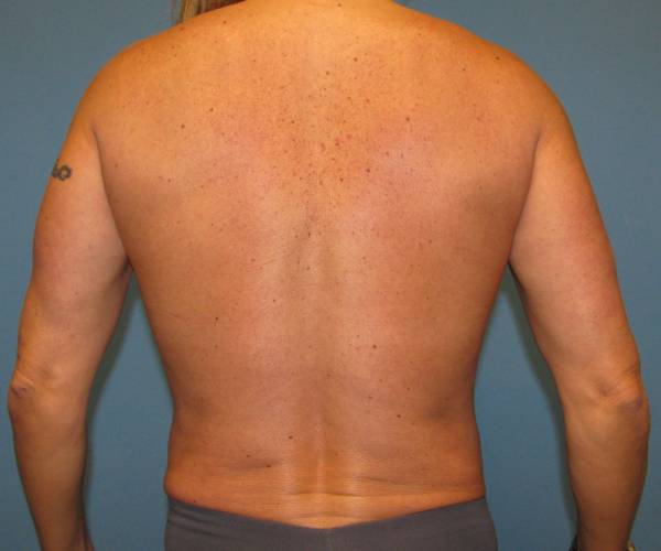 after liposuction back view male patient case 2631