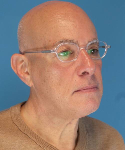 after neck lift male patient right angle view case 2685