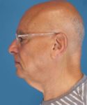 before neck lift male patient left side view case 2685