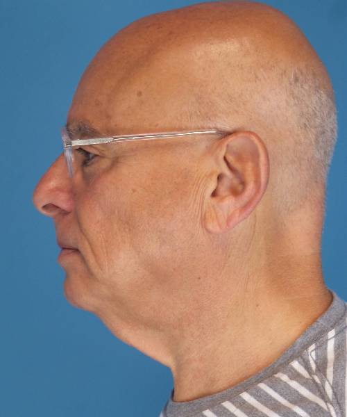 before neck lift male patient left side view case 2685